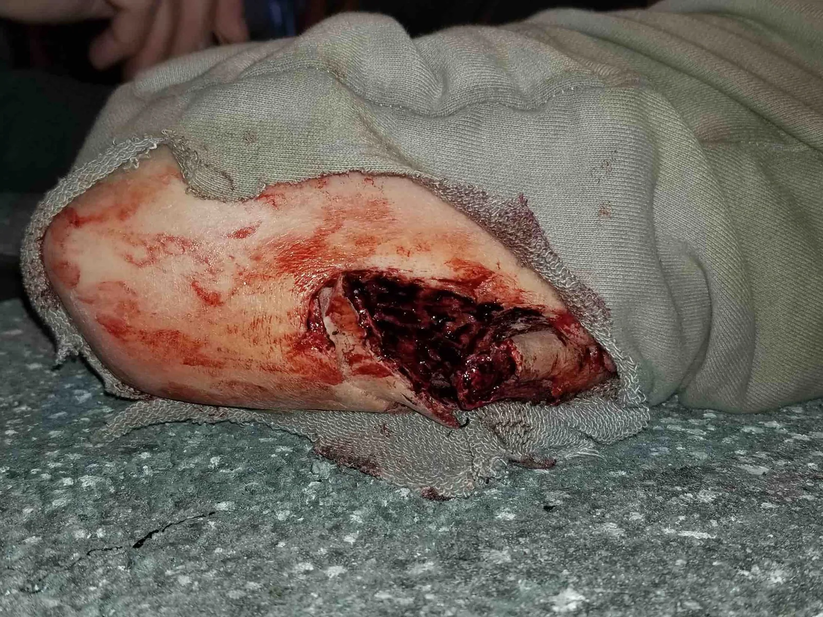 Broken Arm makeup on T. Hardy body double for "Venom"